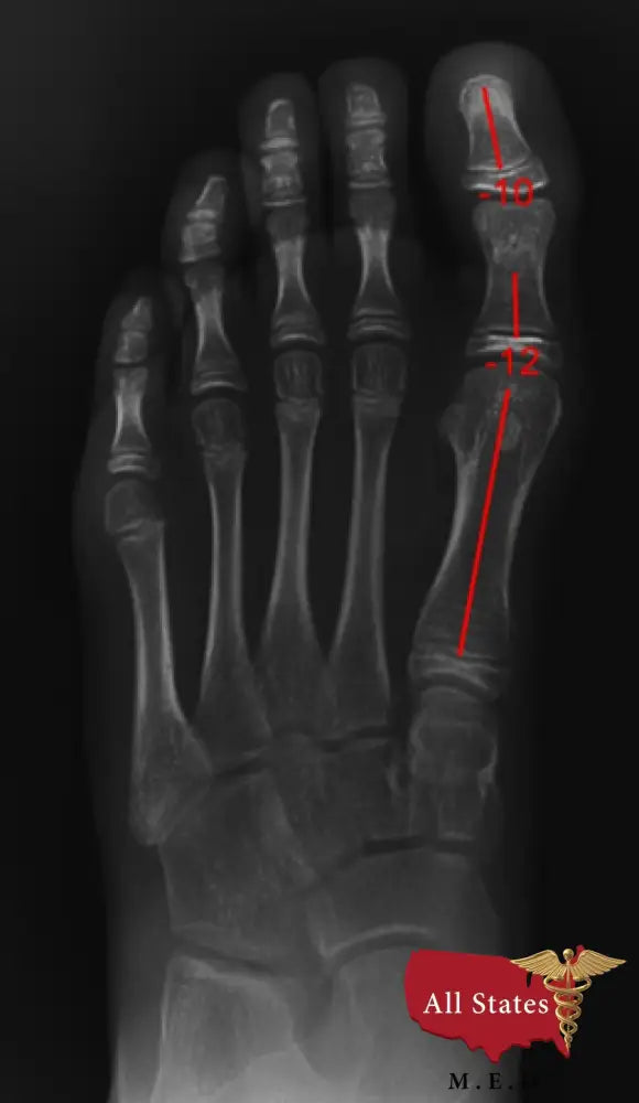 A2D2 Digital Xray With Refurbished Xcel Xray