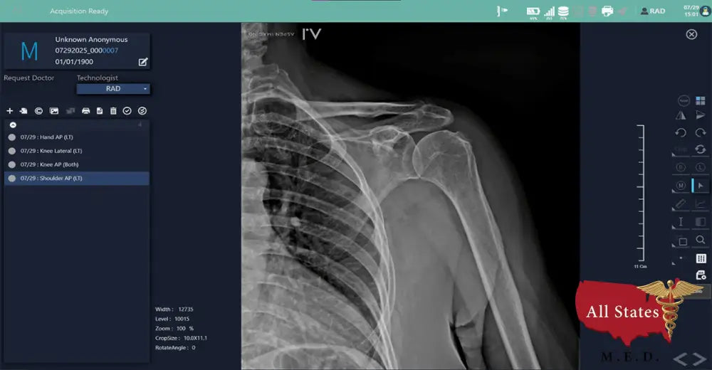 Hand Held Digital X-ray Europa 85