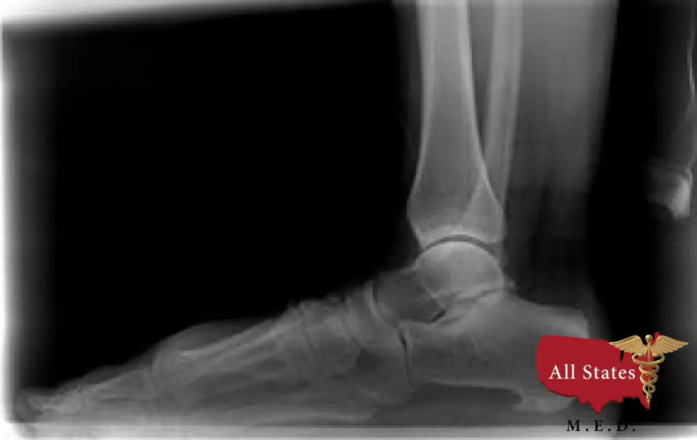 A2D2 Digital Xray With Refurbished Xcel Xray