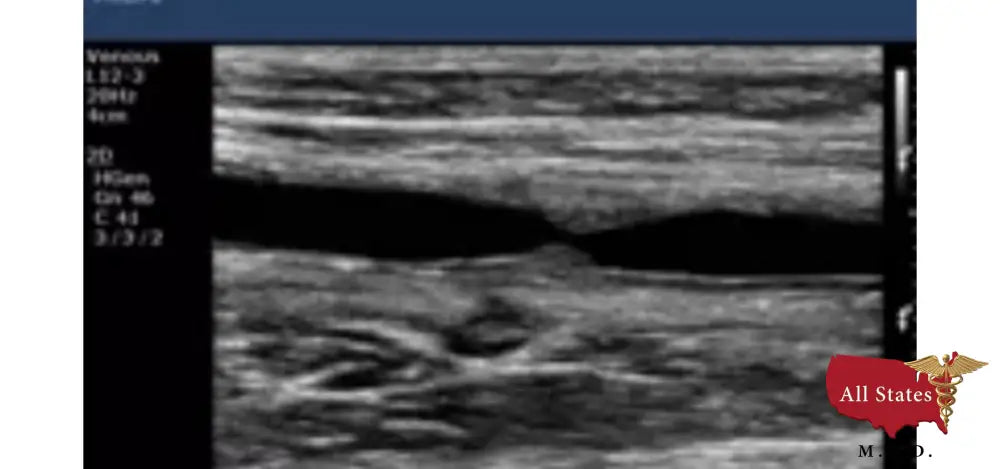 Philips CX50 Refurbished with 3 Probes