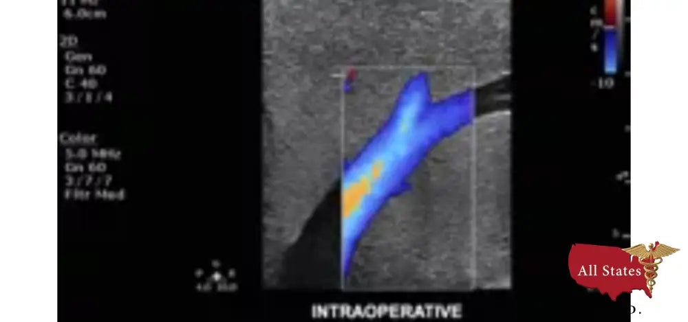 Philips CX50 Refurbished with 3 Probes