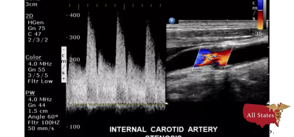 Philips CX50 Refurbished with 3 Probes